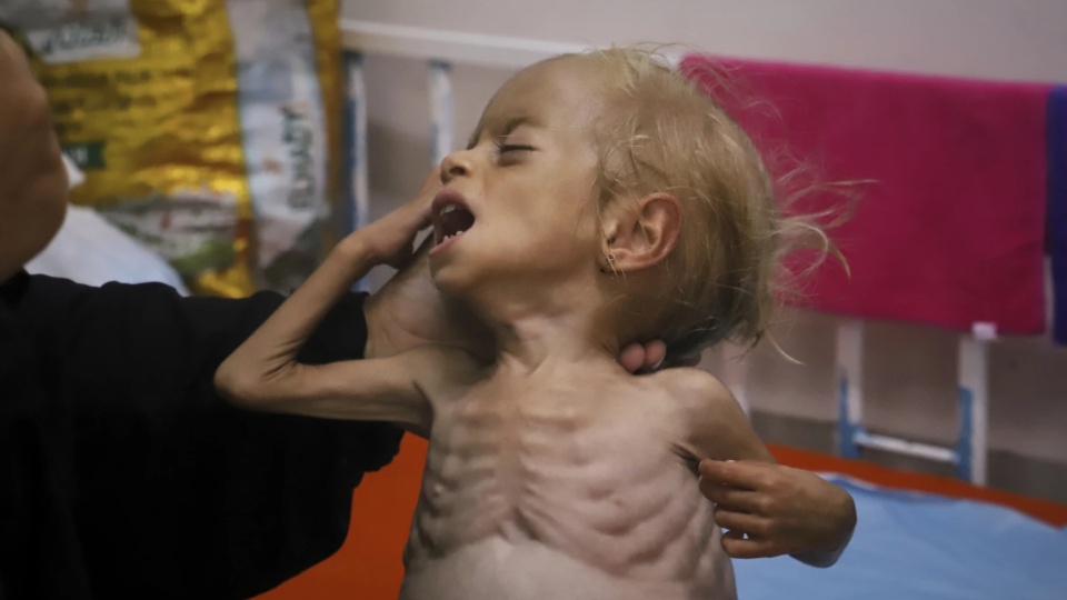 Gaza children are skin-and-bones, but Netanyahu says no one’s hungry